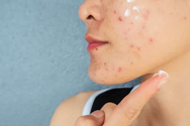 Top 10 Clindamycin Nicotinamide Cream Brands in India