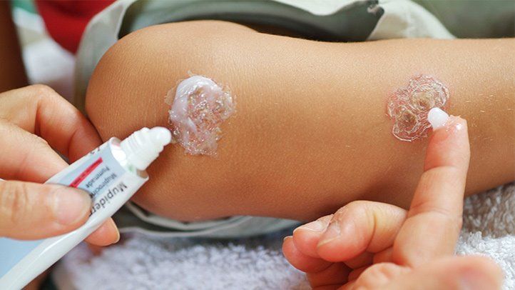 Top 10 Mupirocin Cream Brands in India